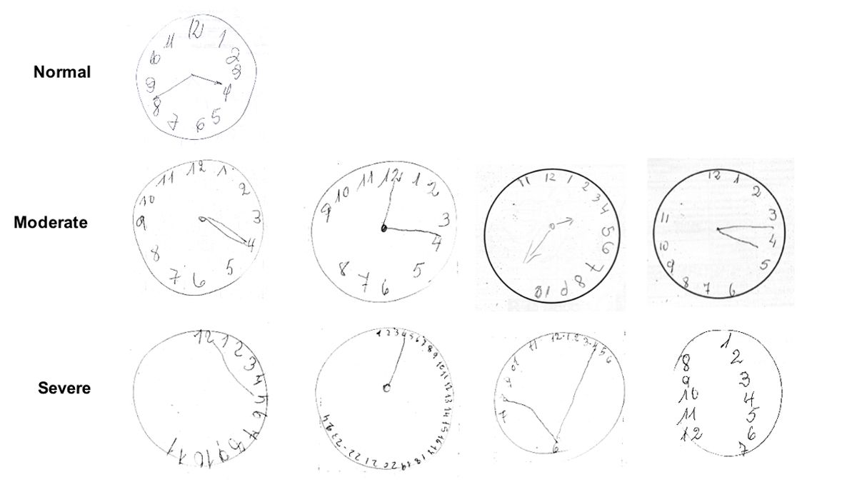 An Introduction to the Clock Drawing Test in Hypertension | Technology  Networks
