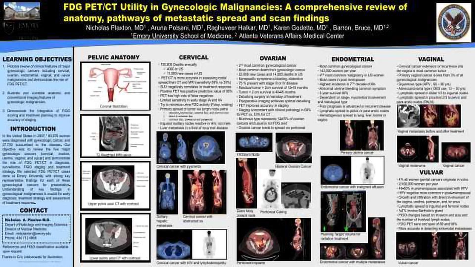 FDG PET/CT Utility in Gynecologic Malignancies: A comprehensive review of anatomy, pathways of metastatic spread and scan findings content piece image