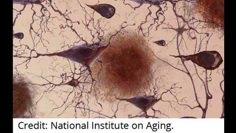 Systems Biology Advances Alzheimer's Research