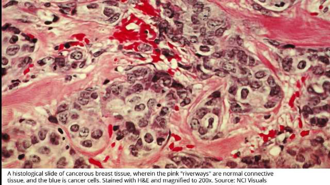 Potential Treatment for Metaplastic Breast Cancer