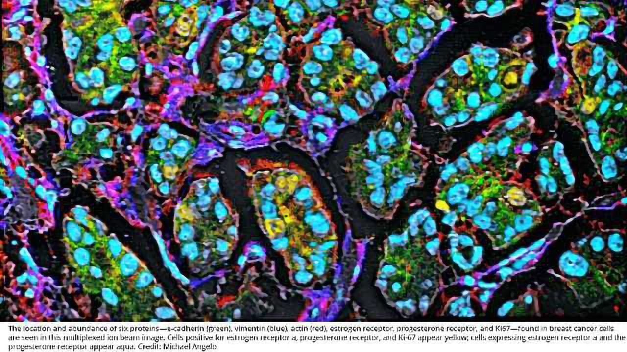 Tumor Suppressor LATS Key Driver of Breast Cancer