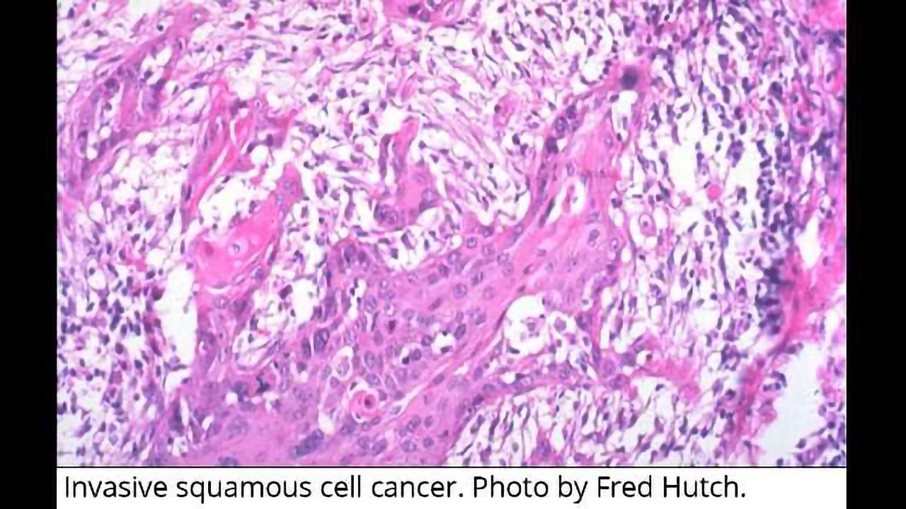 New Subtype of Cervical Cancer Identified