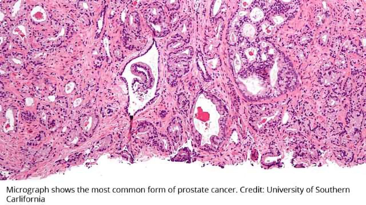 New Strategy for Treating Advanced Prostate Cancer