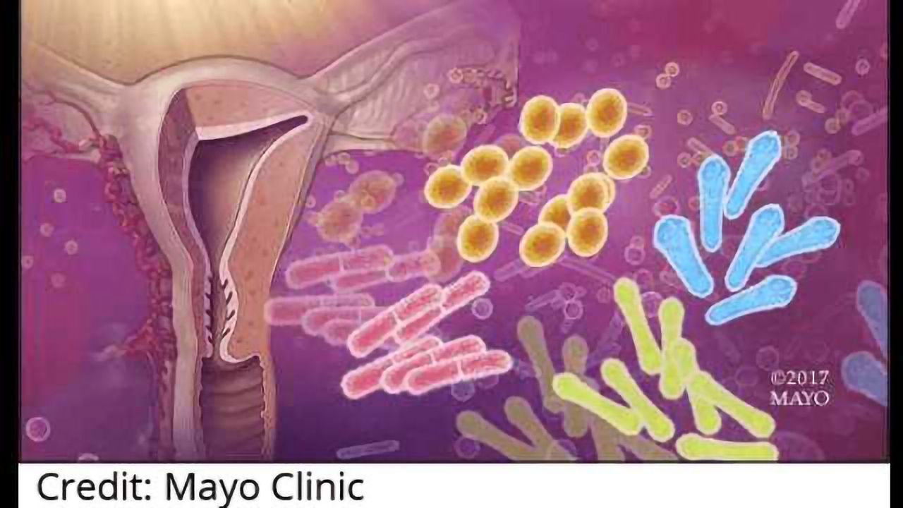 Vaginal Microbes May Play Role in Endometrial Cancer