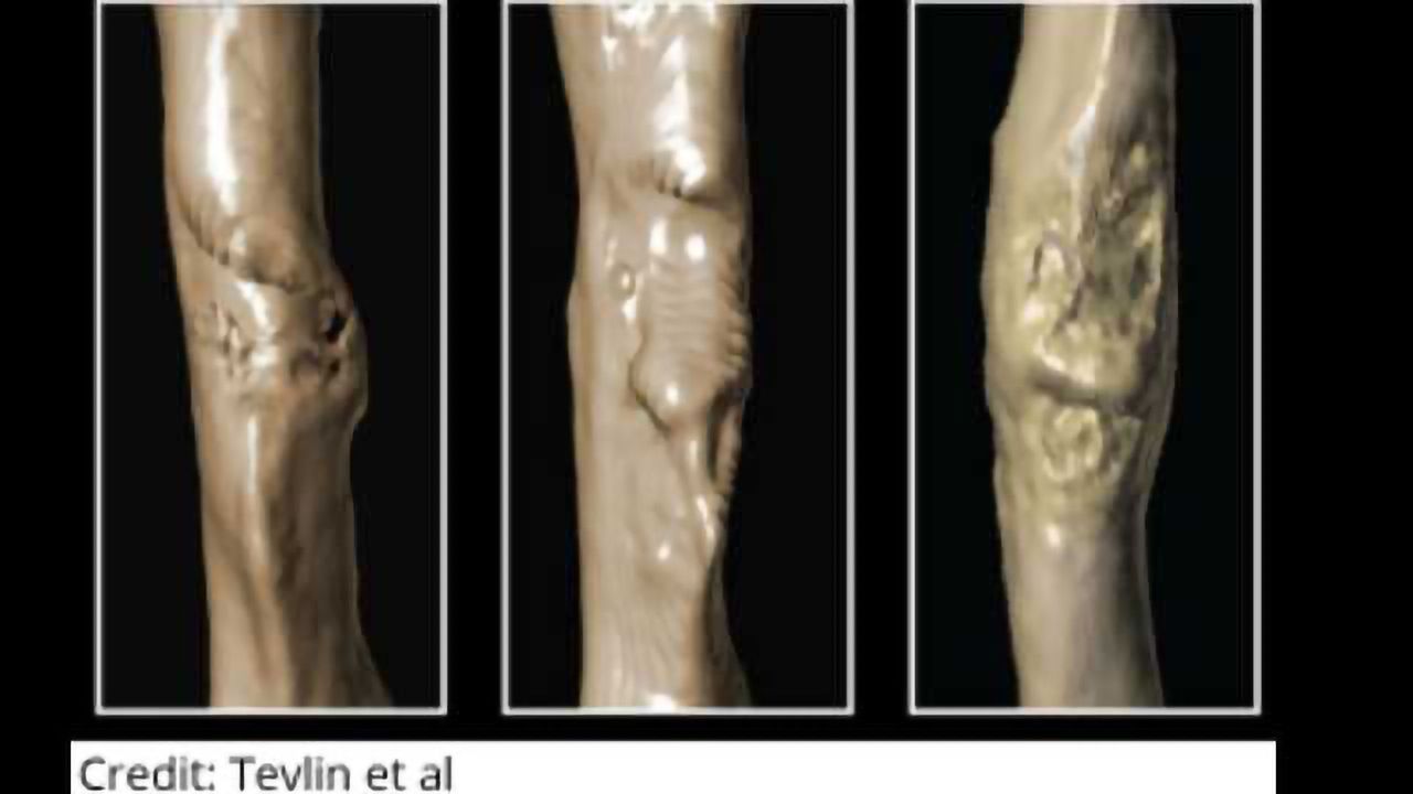 Enhancing Bone Healing in Diabetics