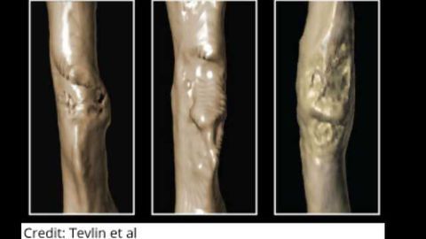 Enhancing Bone Healing in Diabetics