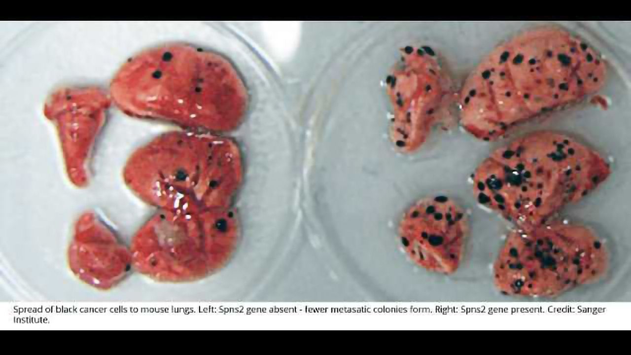 23 Genes Linked to Regulation of Cancer Spread