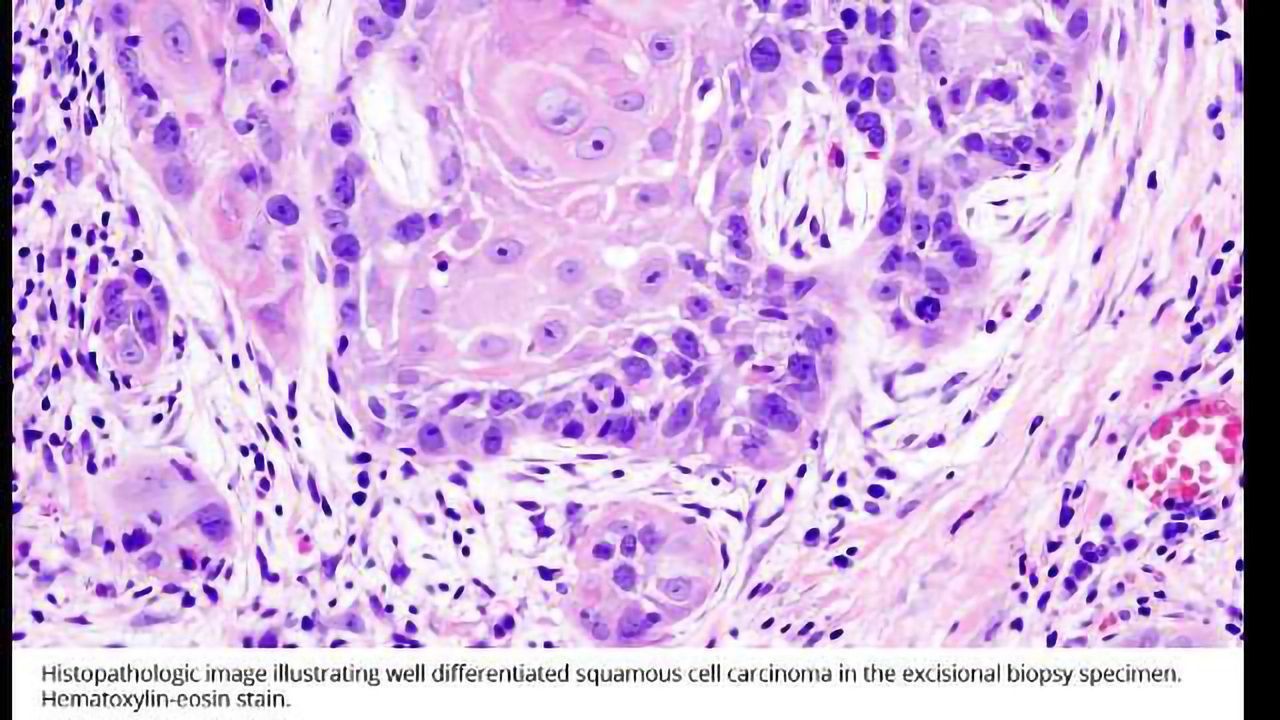 Epigenetic Modification Linked to Throat Cancer