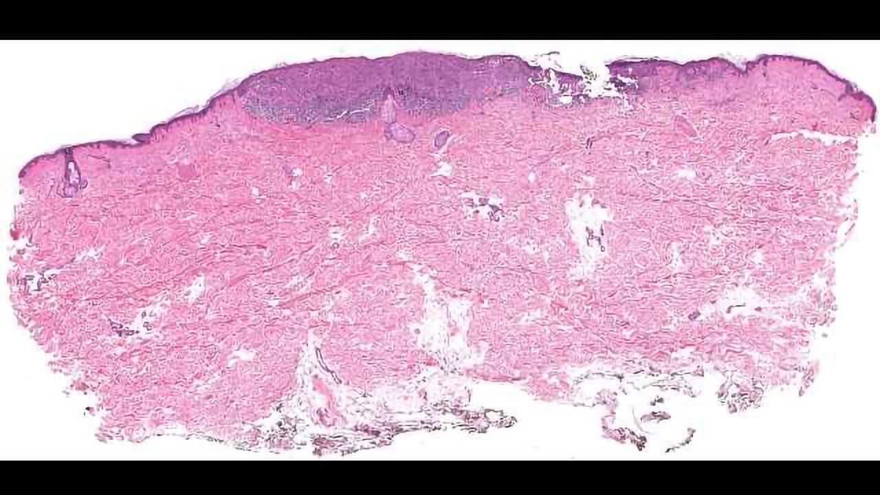Punishing Conditions Drive Cancer Metastasis