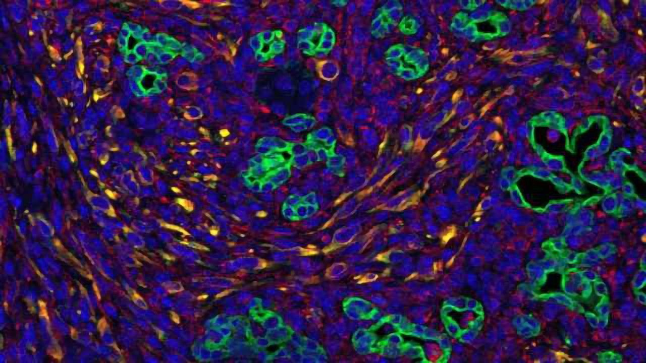 Supportive Cell Signals Encourage Pancreatic Tumor Growth