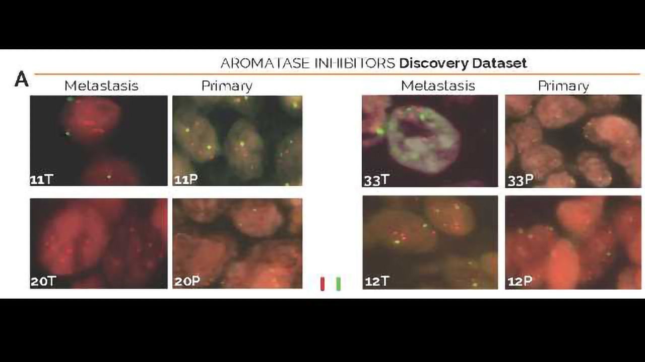 Breast Tumours Evolve to Make Their Own "Fuel Supply"