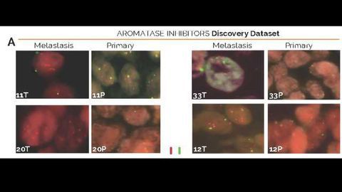 Breast Tumours Evolve to Make Their Own "Fuel Supply"