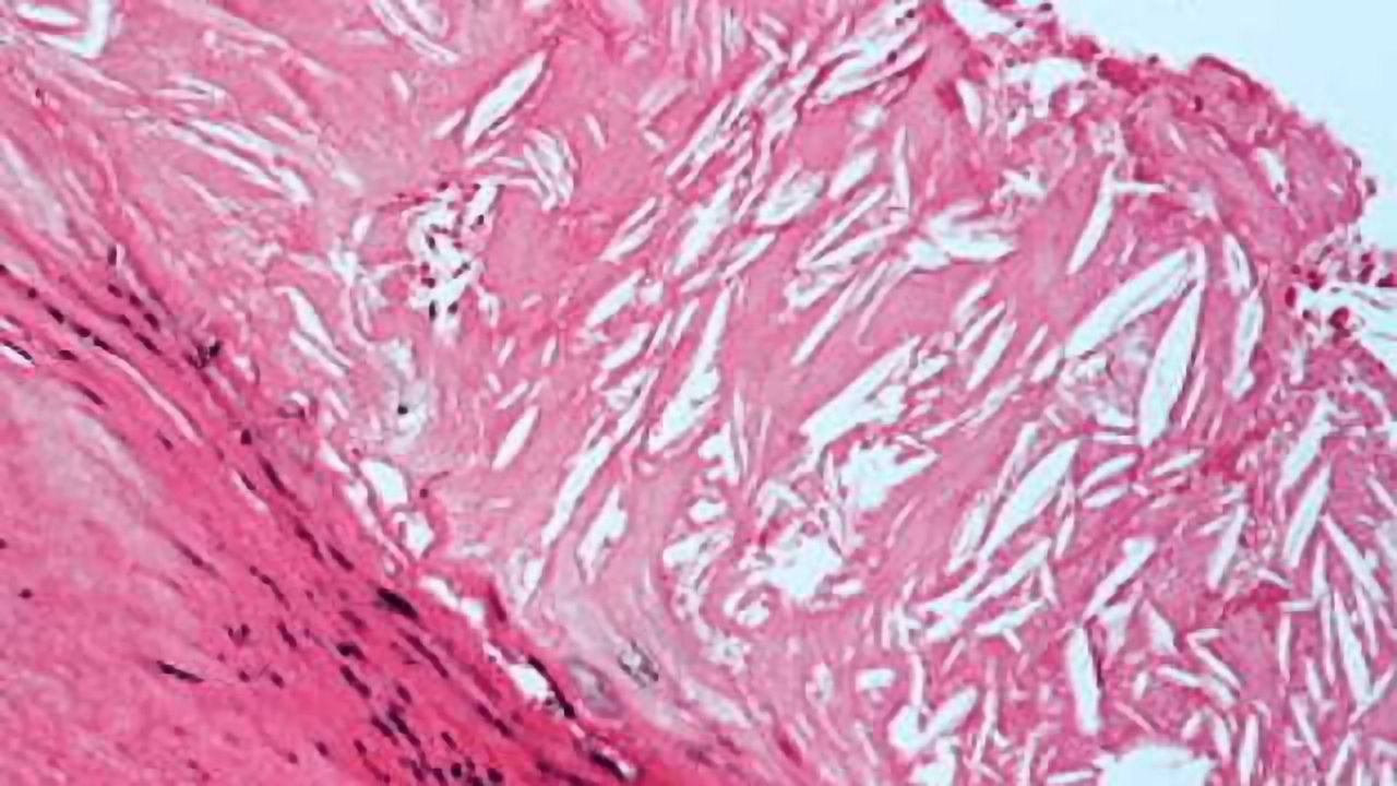 Blood Cell Mutation Linked to Heart Disease