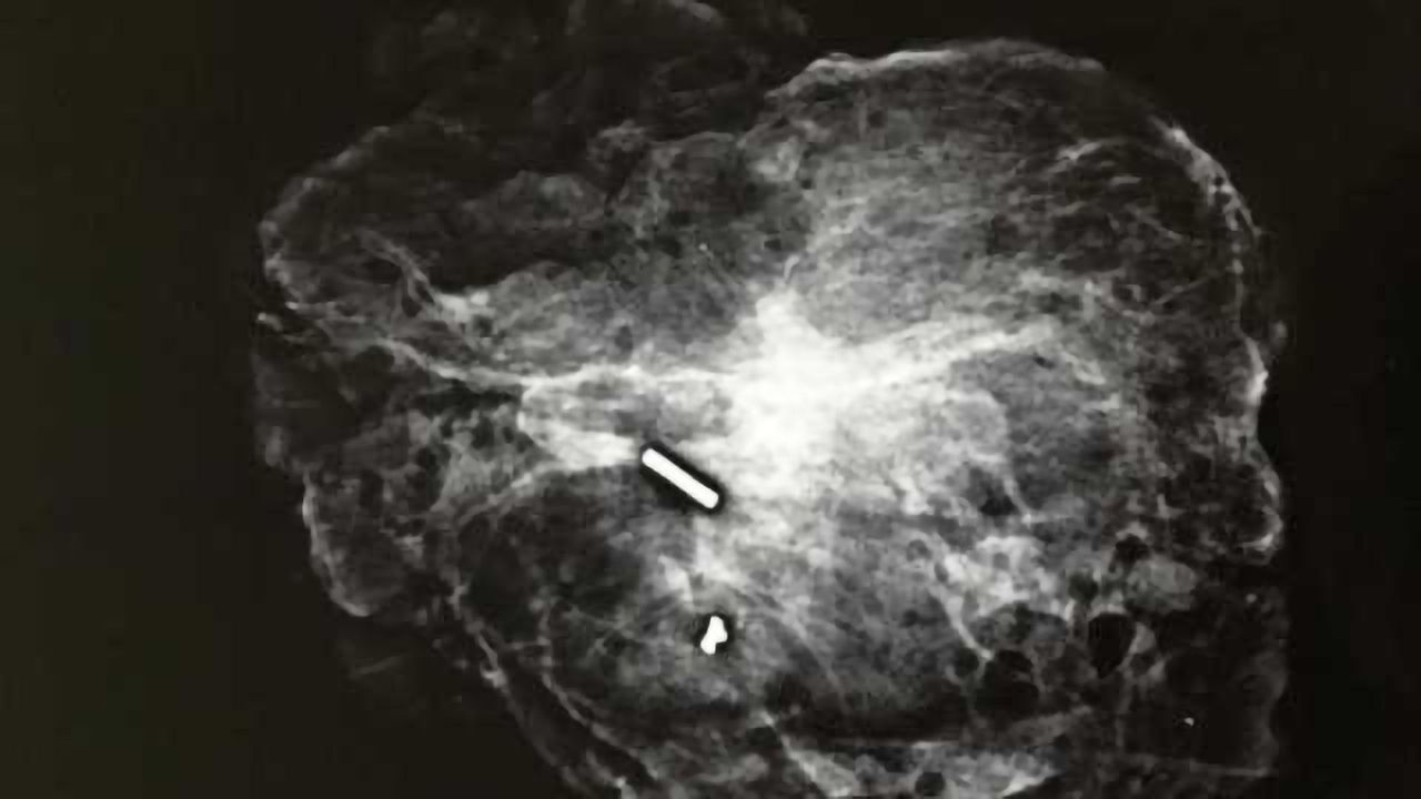 UCSF Adopts Magseed as Standard of care for Localization of Impalpable Breast Lesions