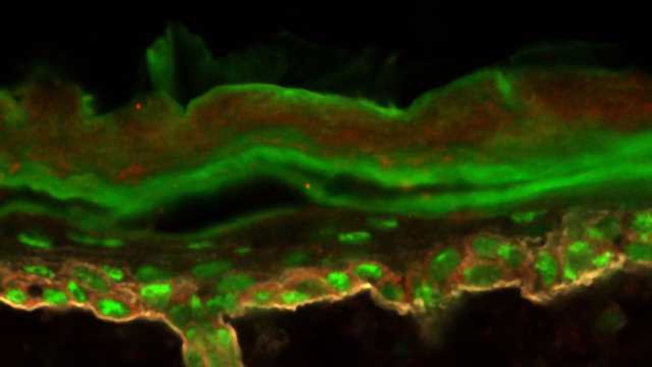 Exploring Why Protein Production Goes Haywire in Cancer