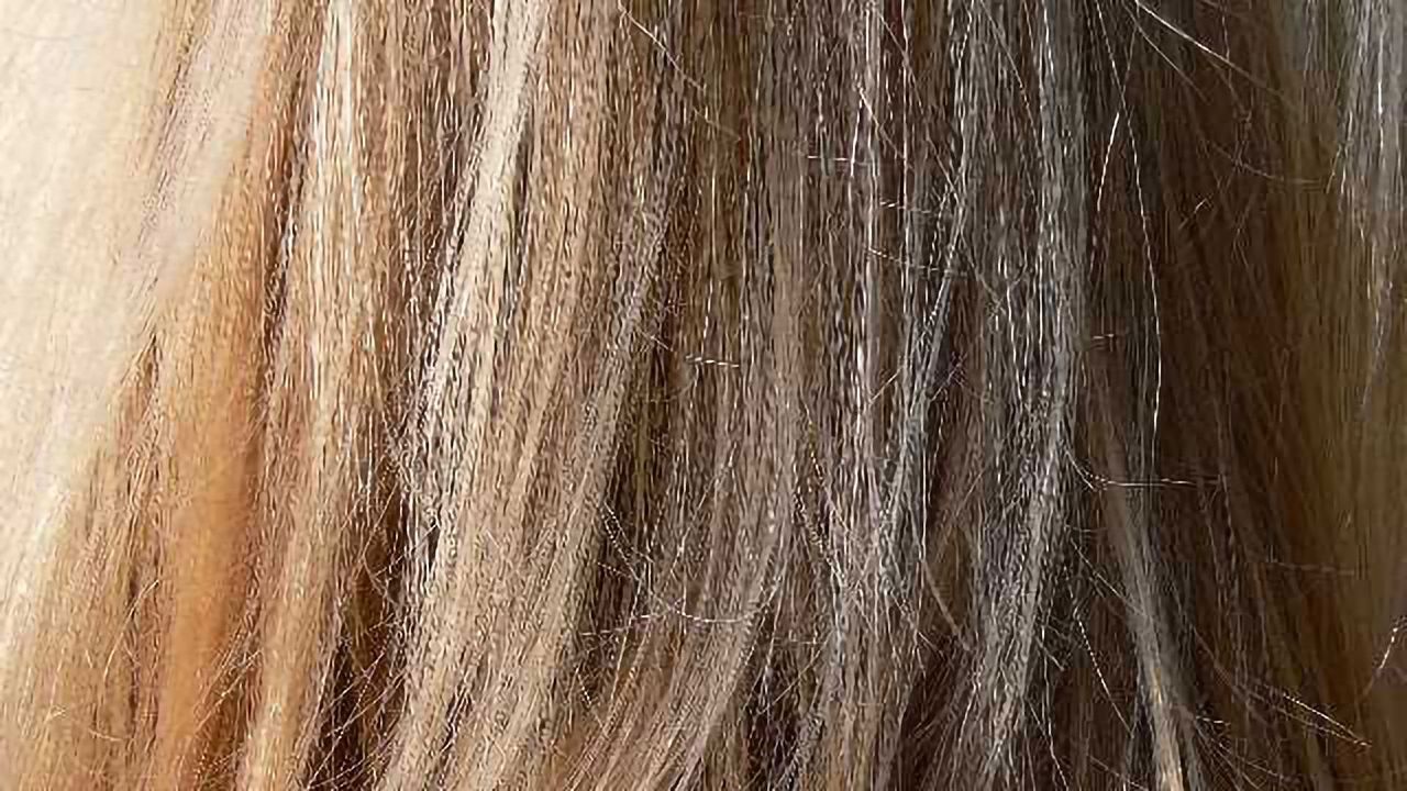 Diagnosing Cushing Syndrome with Hair Analysis