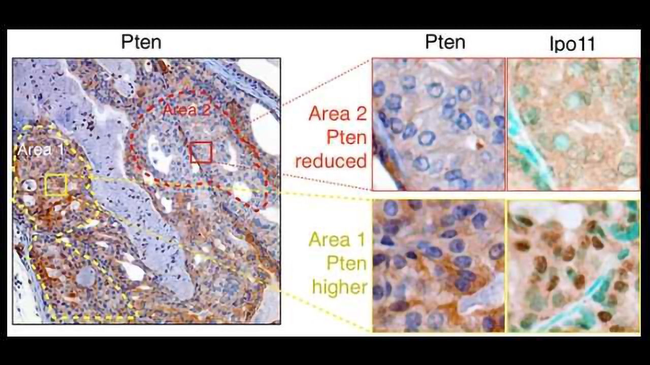 Achilles Heel of Cancer Preventing Protein Discovered