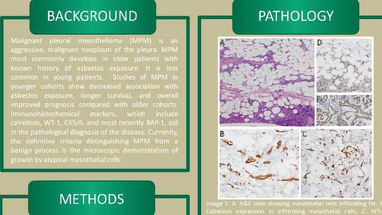 Rare Diagnosis of Malignant Mesothelioma in a Young Patient with Rheumatoid Arthritis
