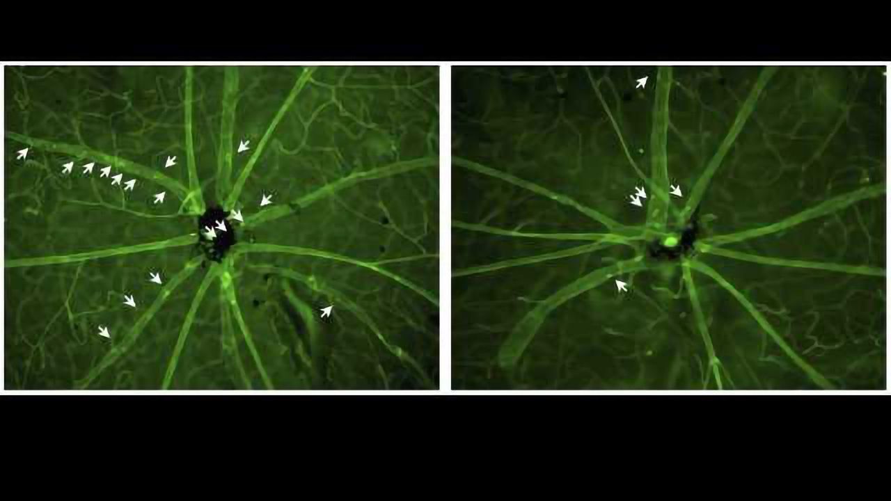 New RNAi Treatment Targets Eye Inflammation