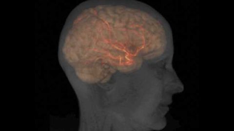 Landmark study to guide protocol for stroke patients