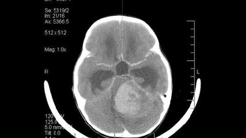 Adult cancer drugs showing promise against medulloblastoma now being used in pediatric clinical trial