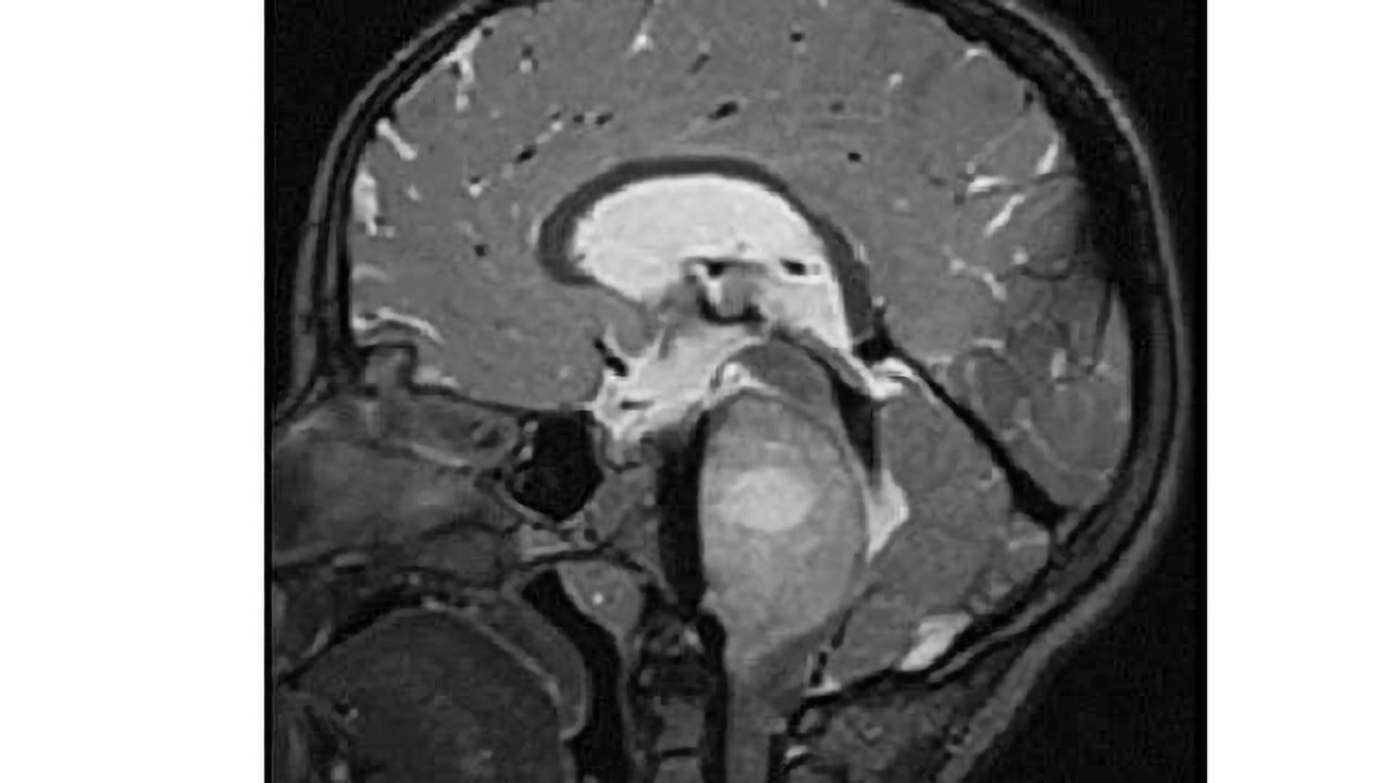 Gene sequencing project uncovers mutations tied to deadly pediatric high-grade glioma brain tumors