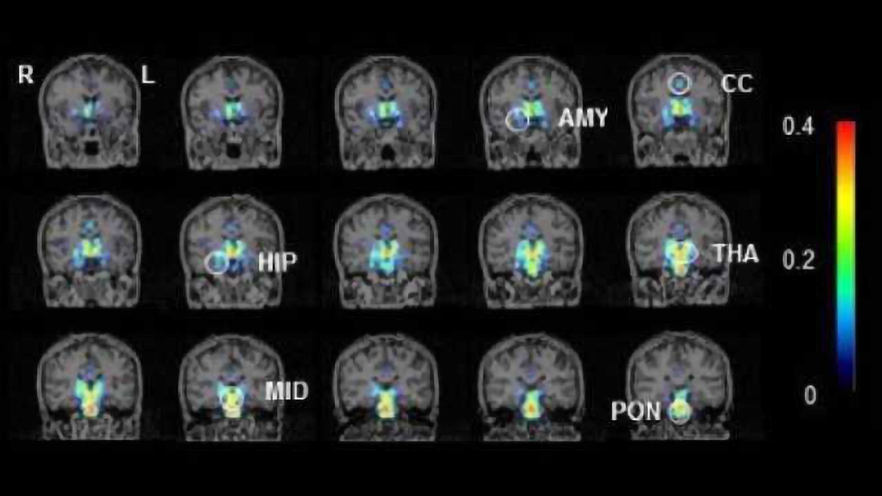 Toward a clearer diagnosis of chronic fatigue syndrome