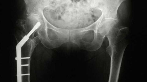 Study Finds Nerve Damage After Hip Surgery May Be Due to Inflammation Study Finds Nerve Damage After Hip Surgery May Be Due to Inflammation