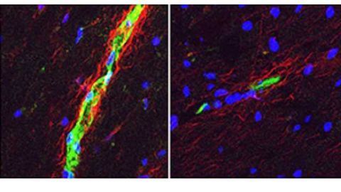 Study helps explain why MS is more common in women Study helps explain why MS is more common in women