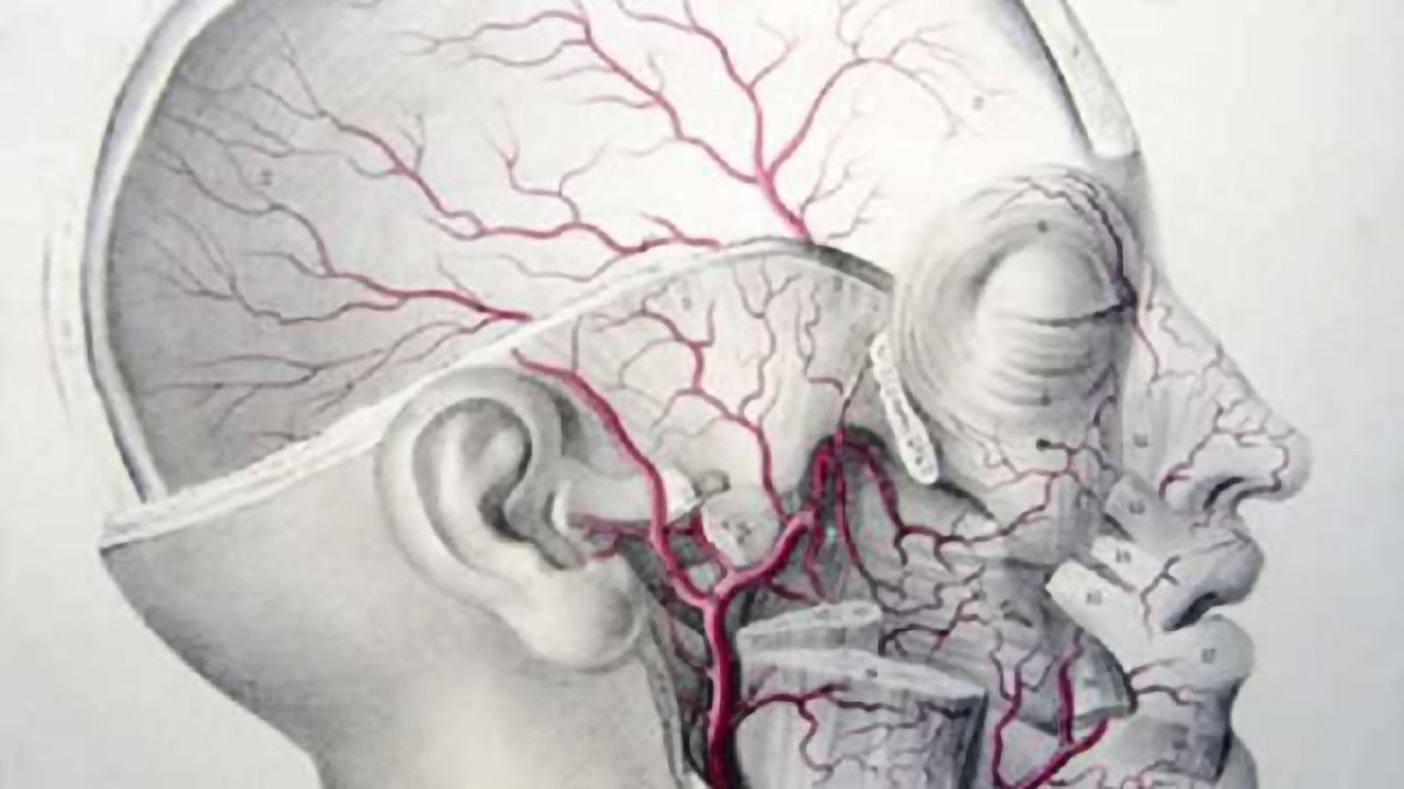 Study examines association between small-vessel disease, Alzheimer pathology