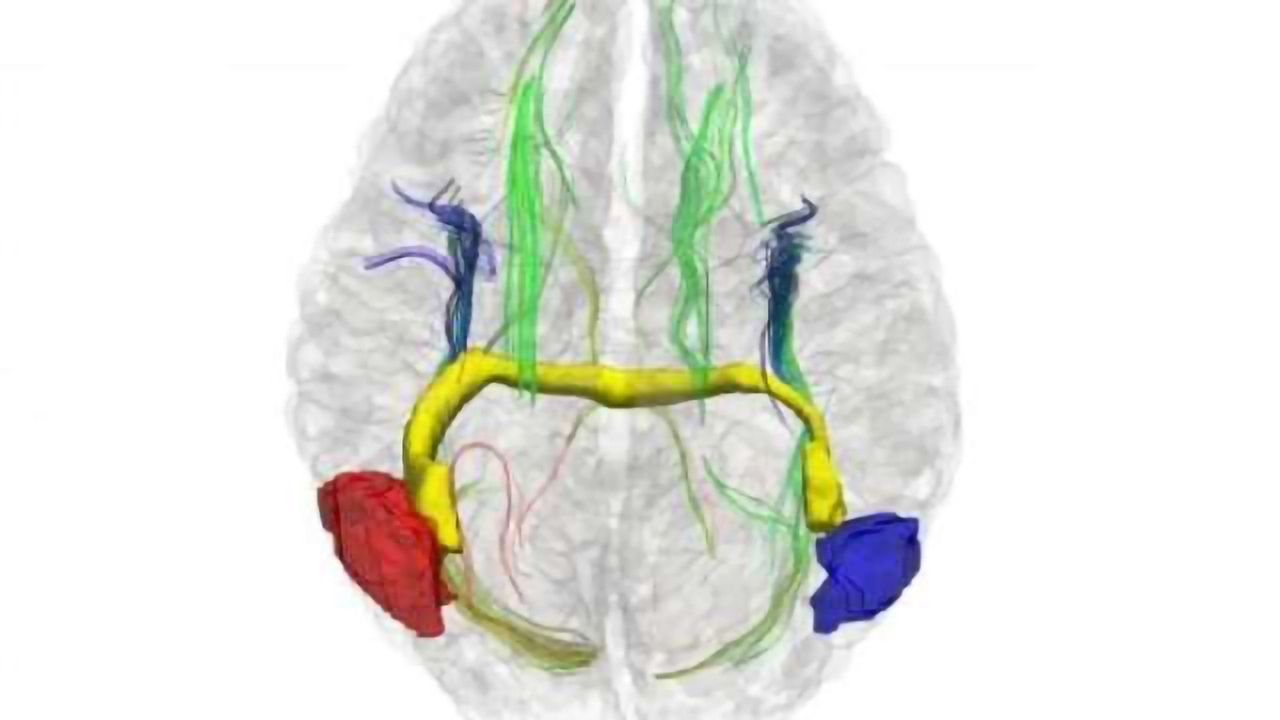Alternative pathways let right and left communicate in early split brains