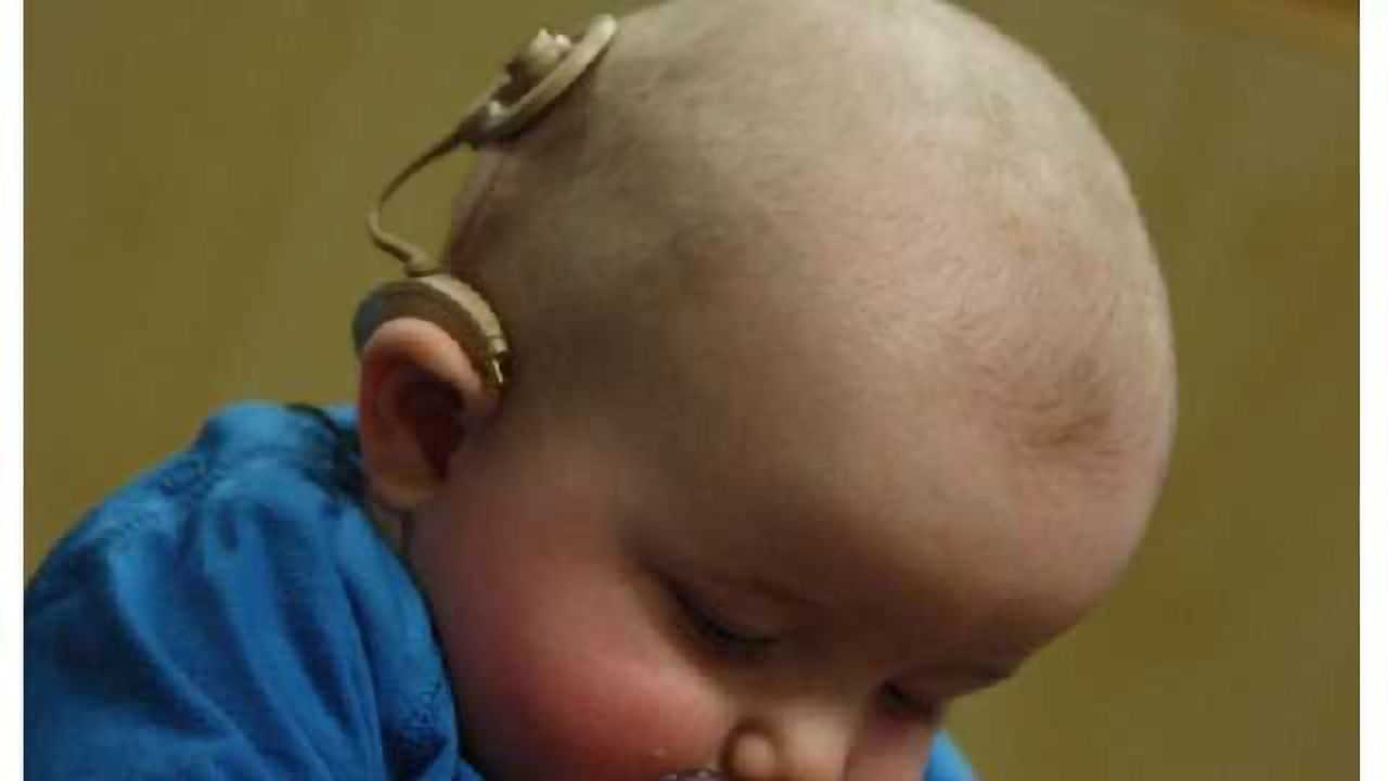 Pattern of cognitive risks identified in some children with cochlear implants