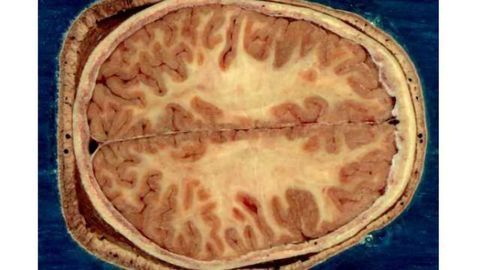 Disorders of compulsivity share common pattern, brain structure