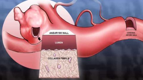 A tool to better screen and treat aneurysm patients