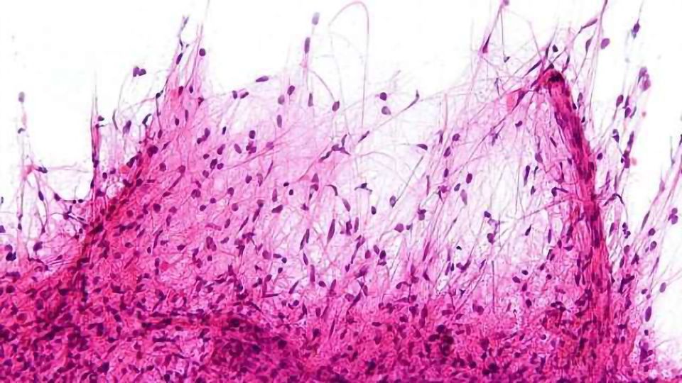 Study Shows Tale of Two Prognoses in Pediatric Brain Tumor, Pilocytic Astrocytoma content piece image