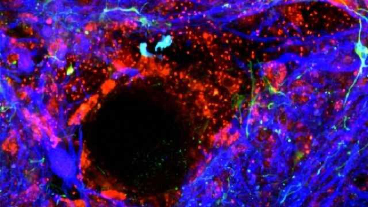 Why inflammation leads to a leaky blood-brain barrier: MicroRNA-155
