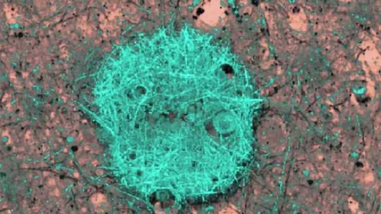 New amyloid-reducing compound could be a preventive measure against Alzheimer’s
