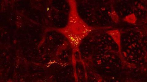 Healthy tissue grafted to the brains of Huntington’s patients also develops signs of the disease