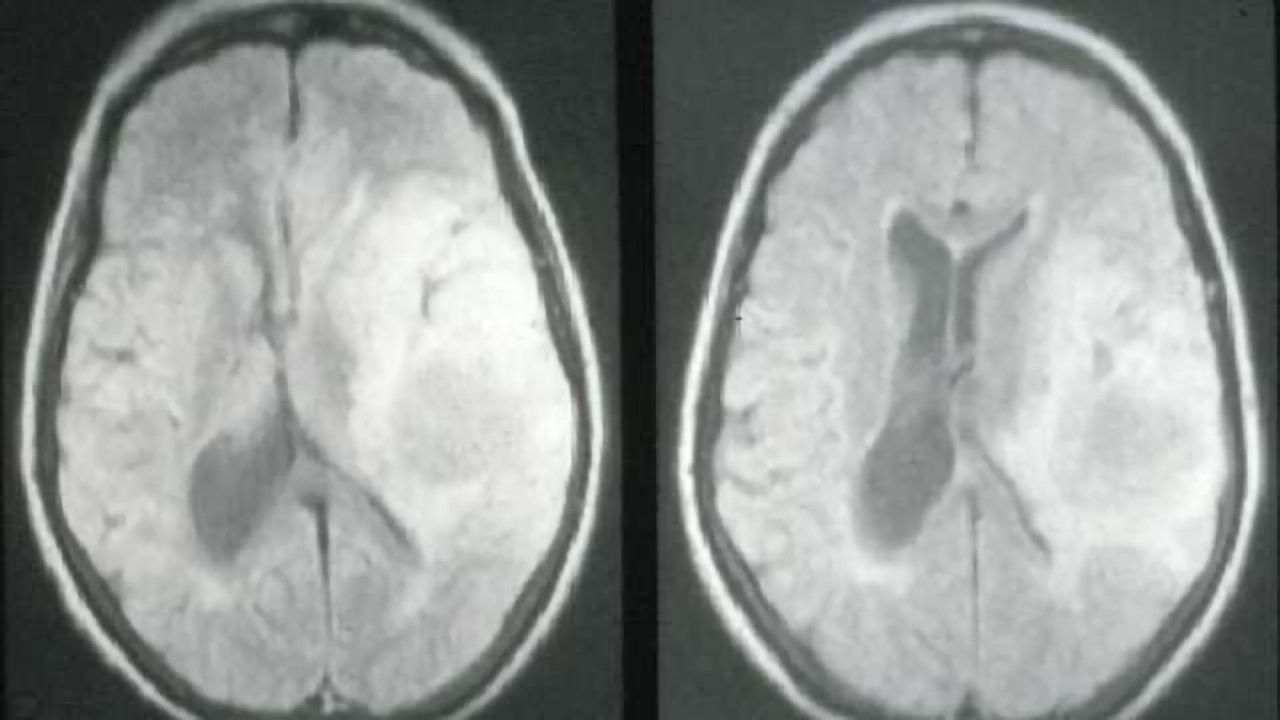 Longer telomeres linked to risk of brain cancer