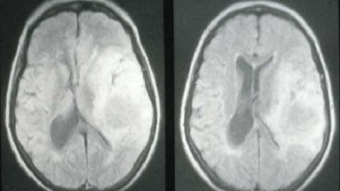 Longer telomeres linked to risk of brain cancer