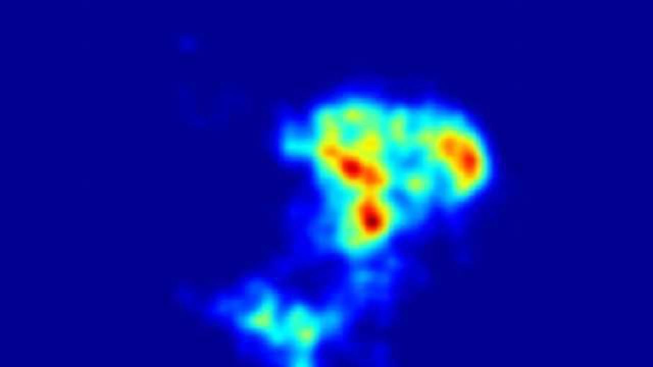 To recover consciousness, brain activity passes through newly detected states