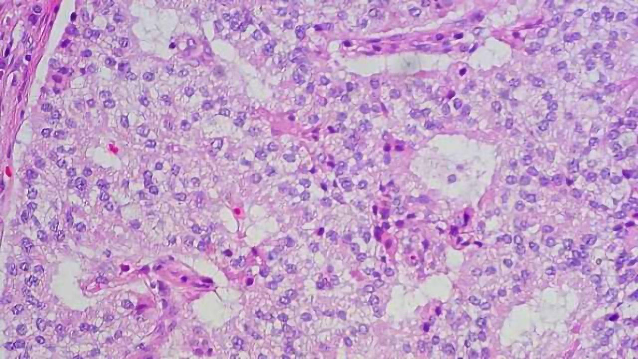 Chemo-Radionuclide Therapy Halts Neuroendocrine Cancer