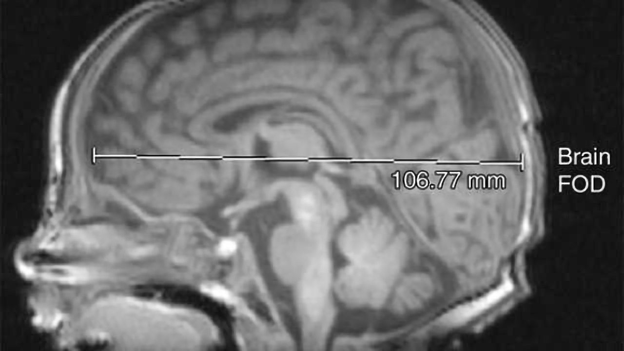 MRI shows brain abnormalities in late preterm infants