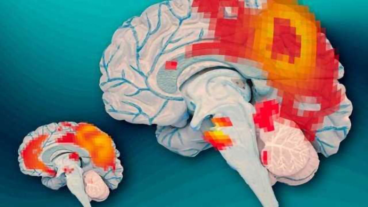 Inside the adult ADHD brain