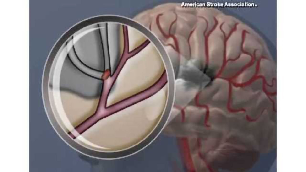 Poor cardiovascular health linked to memory, learning deficits