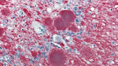 New test detects toxic prions in blood