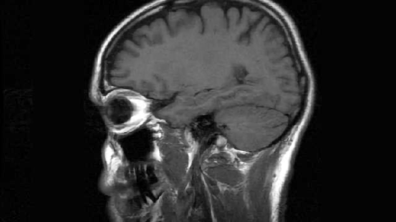 MRI brain scans detect people with early Parkinson's