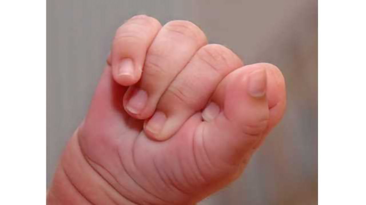 Limited motor skills in early infancy may be trait of autism