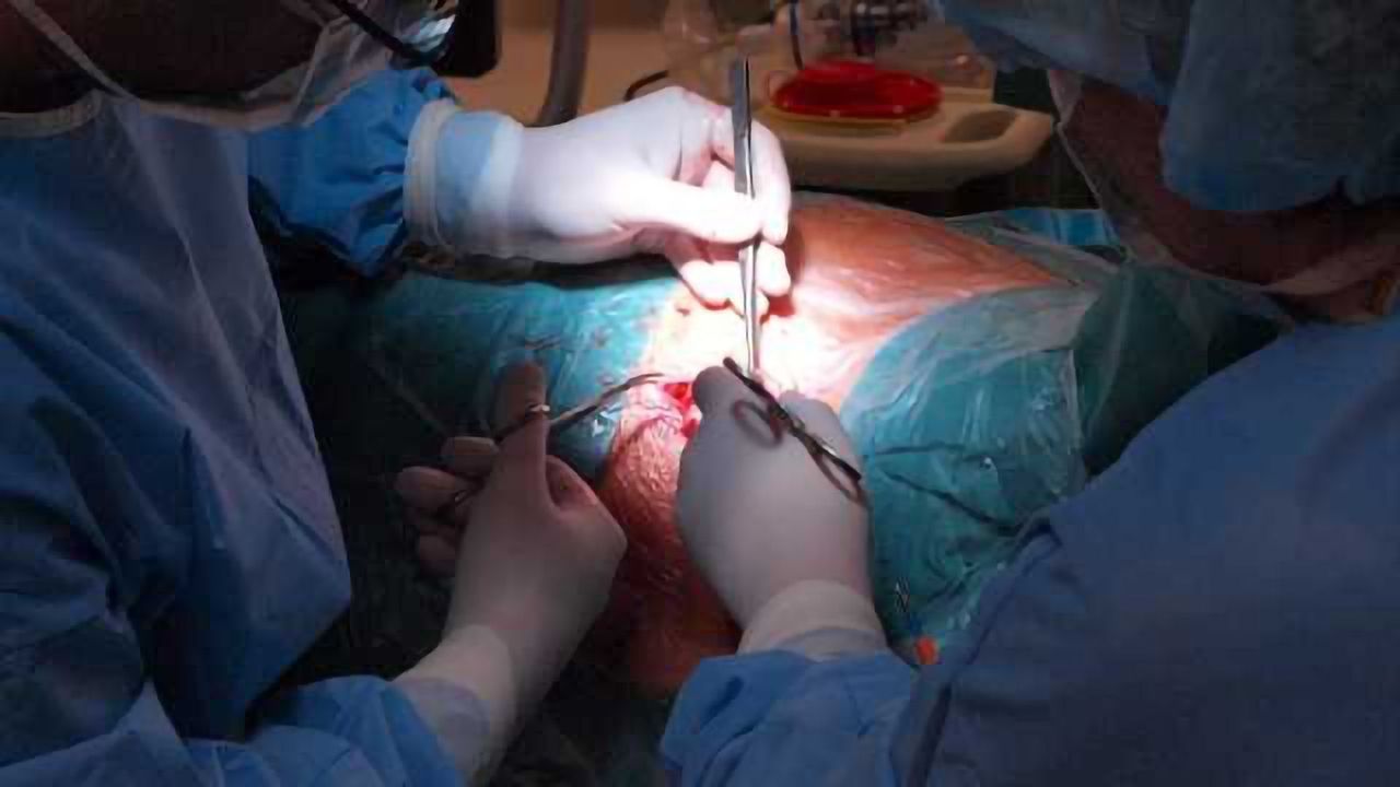 No evidence of long-term PTSD risk in patients with awareness during surgery
