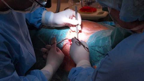 No evidence of long-term PTSD risk in patients with awareness during surgery